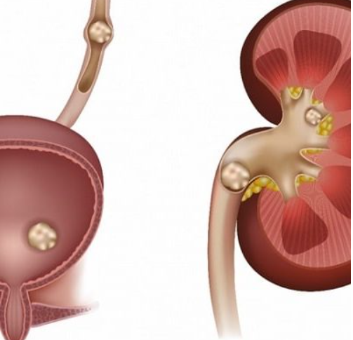 Kidney Stone Illustration