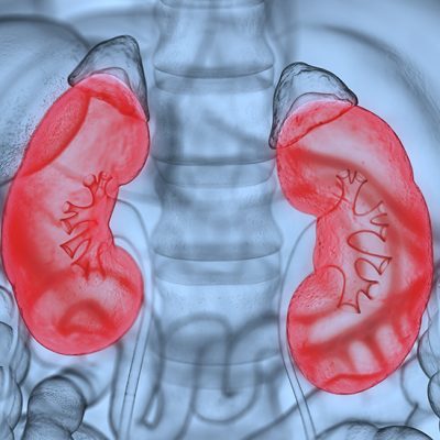 Treatment of Nephrotic Syndrome, protein in urine - Dr. Sachin Patil